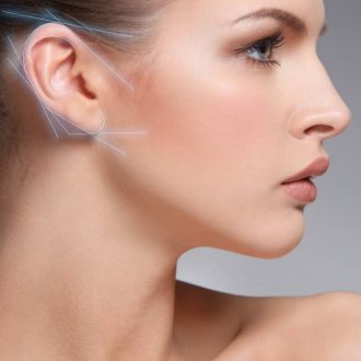 Otoplasty