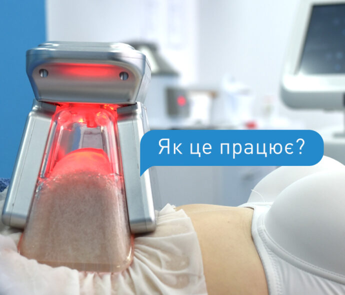 Кріоліполіз - безопераційна ліпосакція