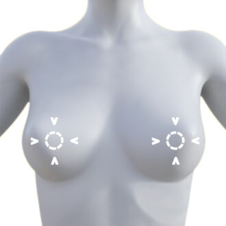 Nipple And Areolar Correction Surgery