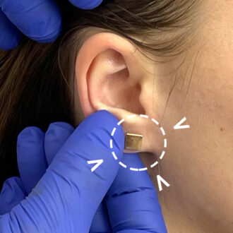 Earlobe Correction